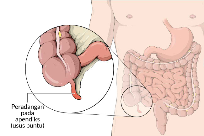 Usus Buntu